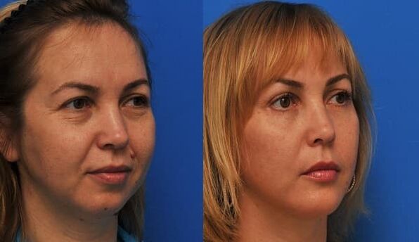 antes e despois do rexuvenecemento da pel con axuste Foto 1