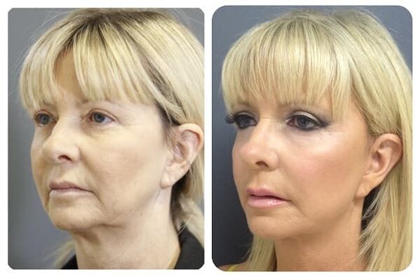 antes e despois do rexuvenecemento da pel con axuste Foto 2