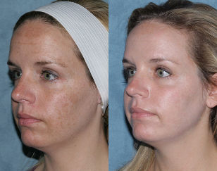 Antes e despois fraccionada rexuvenecemento da cara