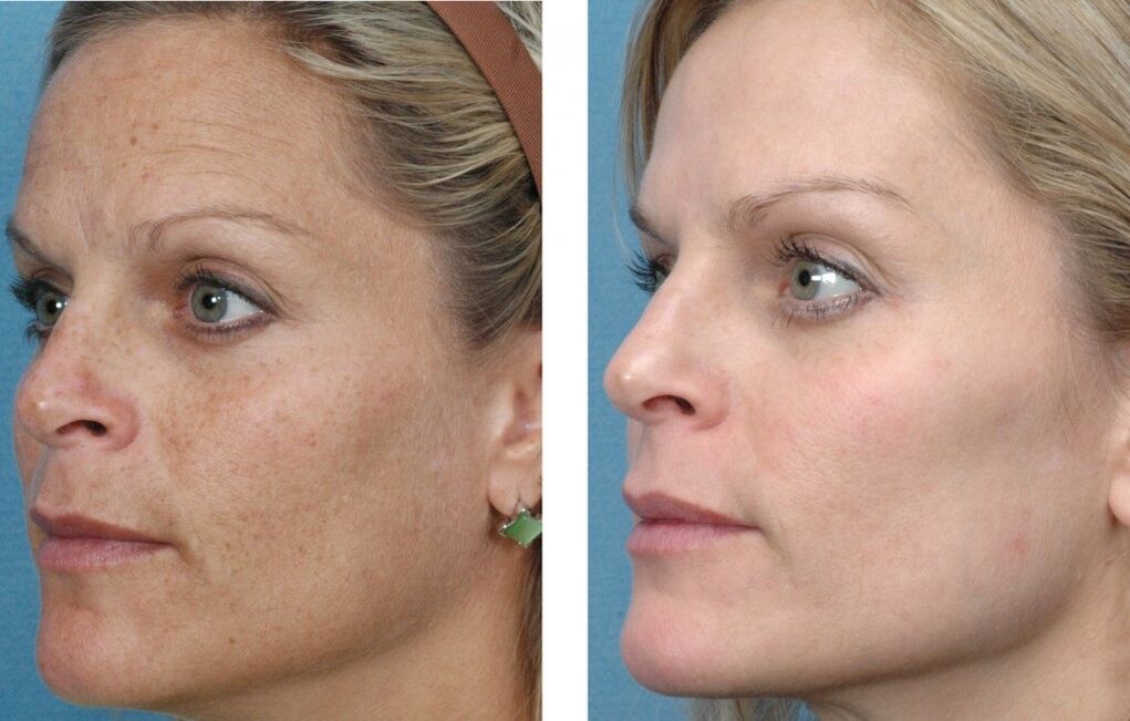 antes e despois do rexuvenecemento da pel