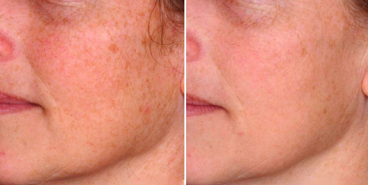 O resultado da fototermólise fraccionada é a redución das manchas de idade na pel da cara. 