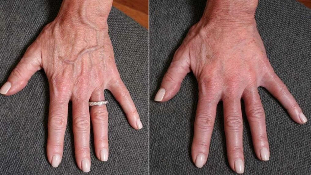 Contorno de plástico, rexuvenecemento das mans Foto 1 antes e despois