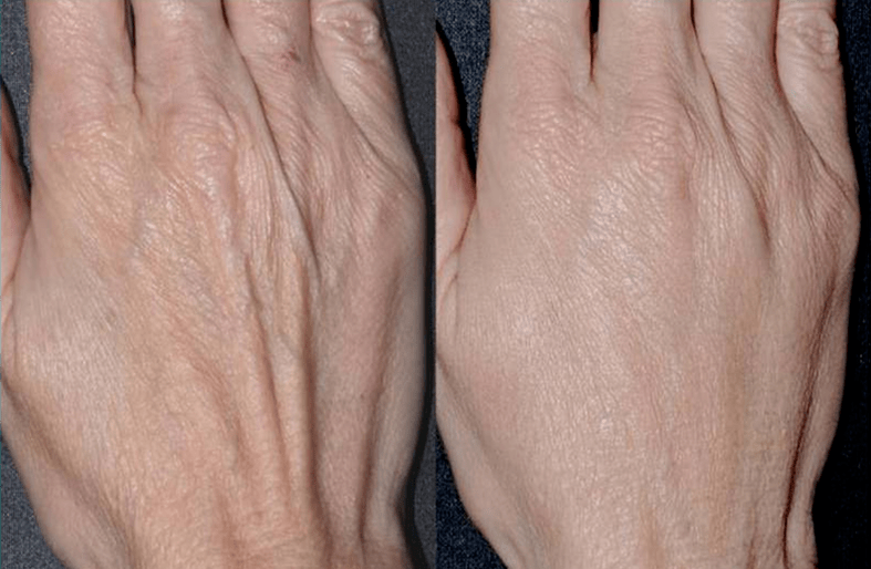 Contorno de plástico, rexuvenecemento das mans Foto 2 antes e despois